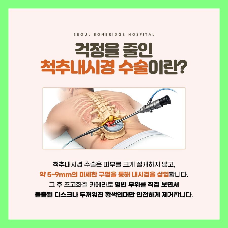 척추내시경 수술 방법 미세 절개 내시경 삽입 서울본브릿지병원 설명